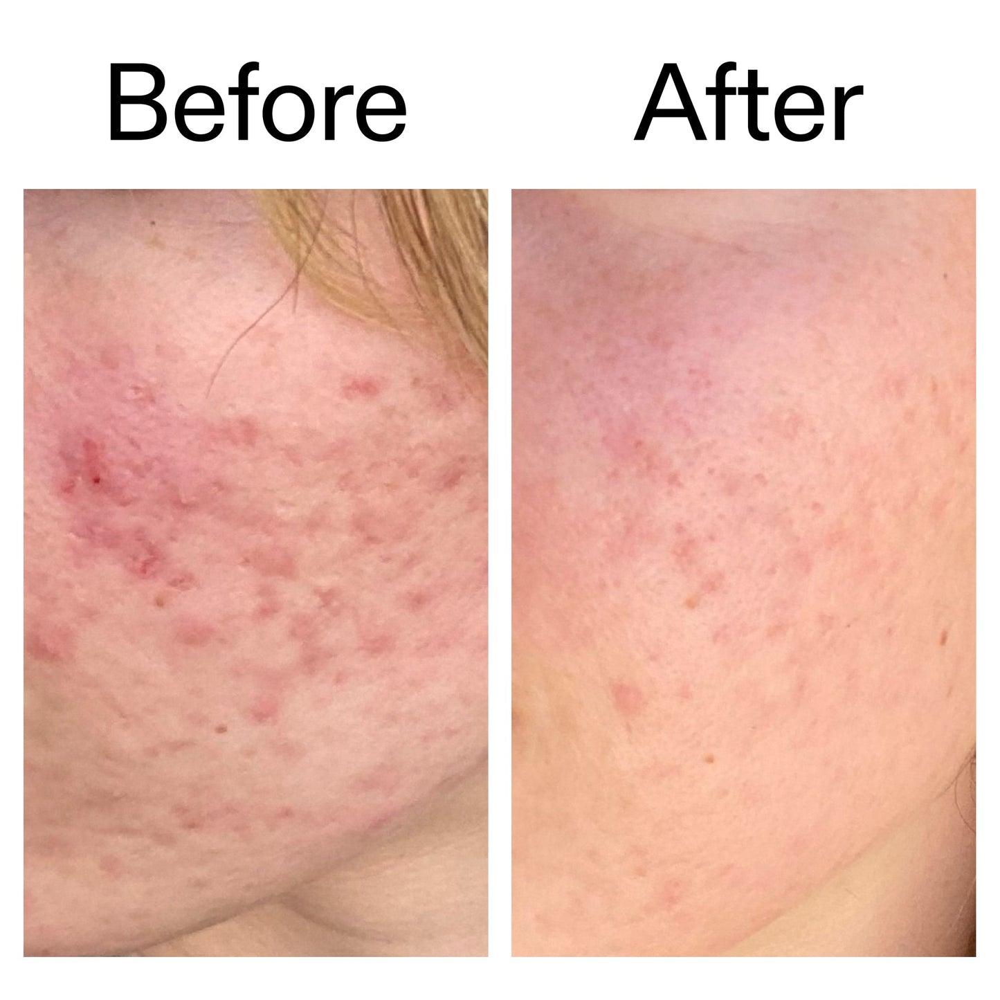 10-azelaic-acid-serum-for-redness-relief-m2 Azealic_Acid_Serum_B_A_Ppage_2000_x_2000.jpg