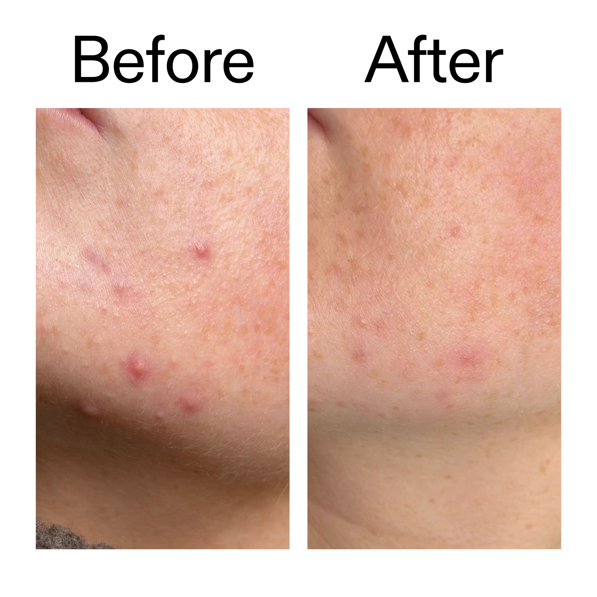 10-azelaic-acid-serum-for-redness-relief-m2 B_A_1_PPAGE.png