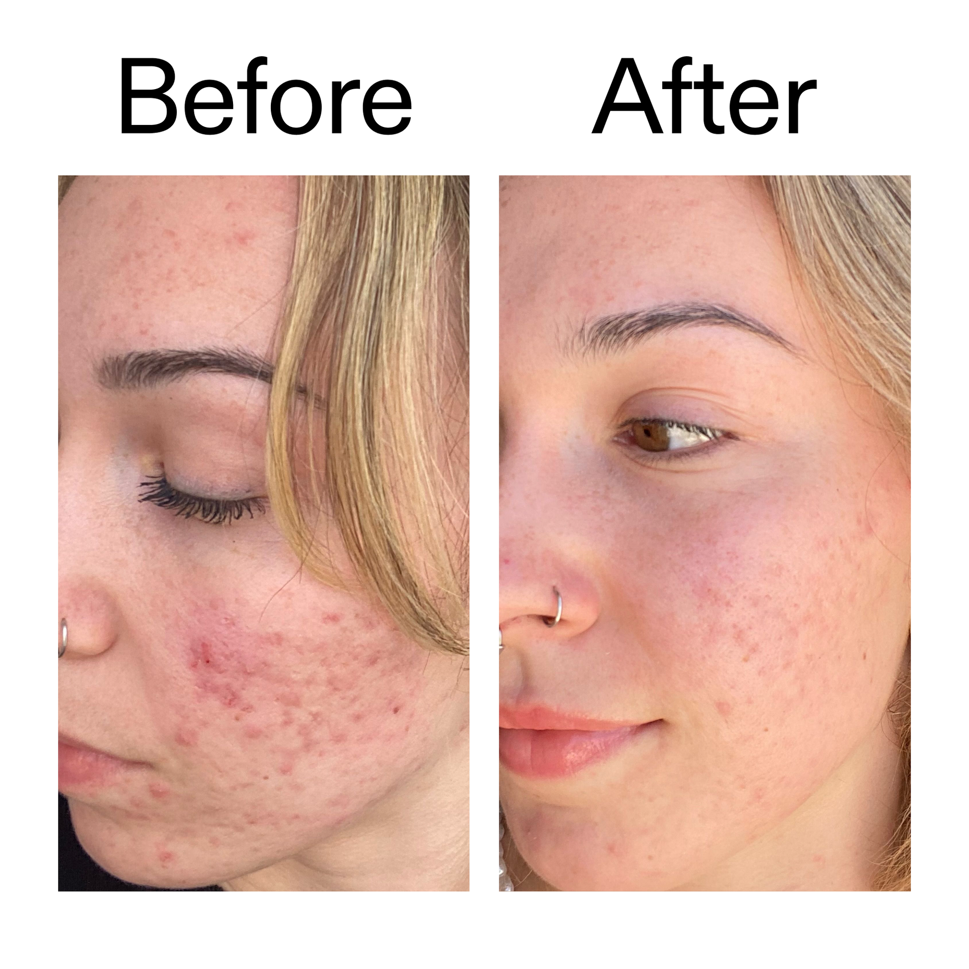 10-azelaic-acid-serum-for-redness-relief-m2 B_A_2_PPAGE.png