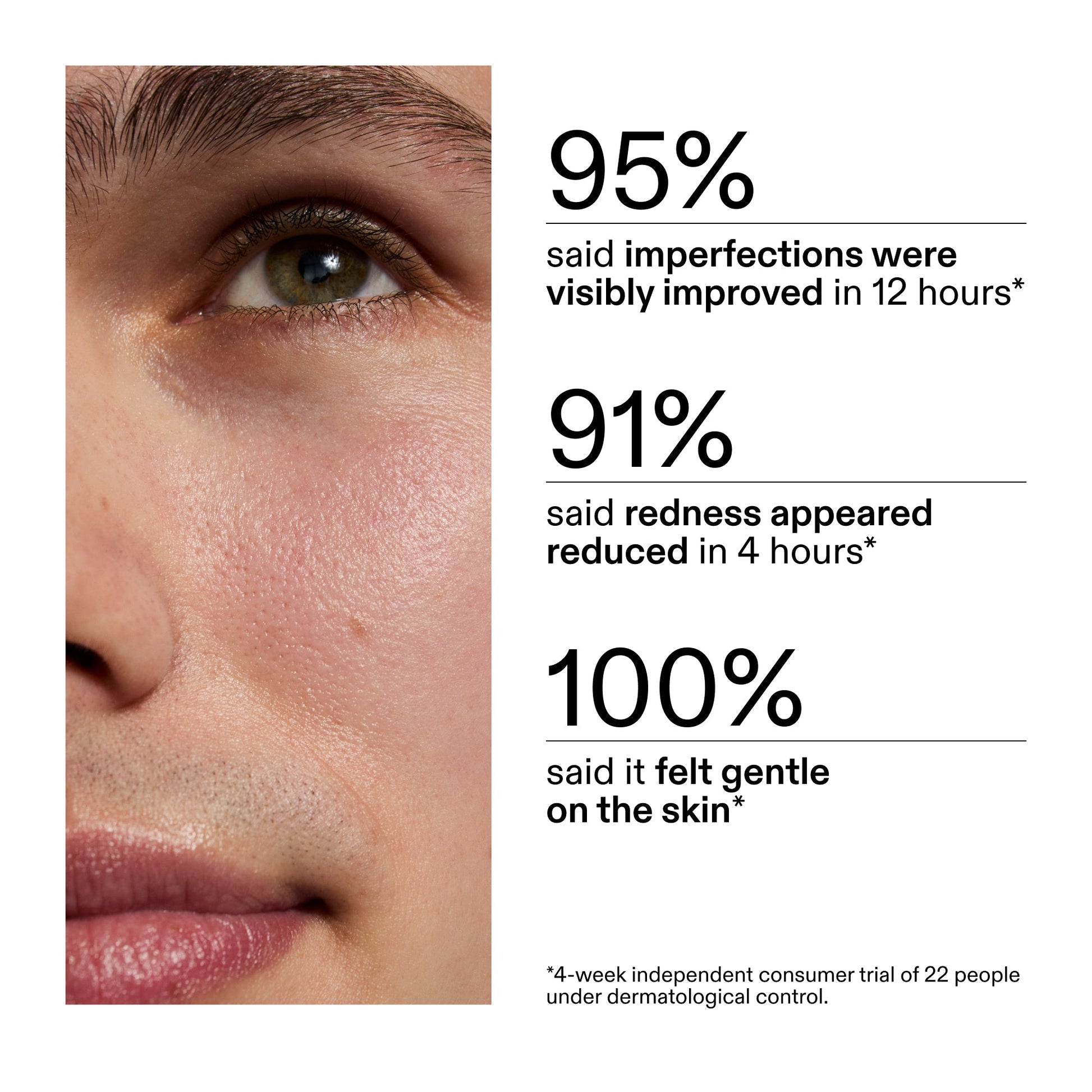 succinic-acid-acne-treatment-u3 CA_Succinic_Acid_Treatment_key_Claims_2000x2000_db91b0f1-7f29-4bfe-bb16-63a47f500960.jpg