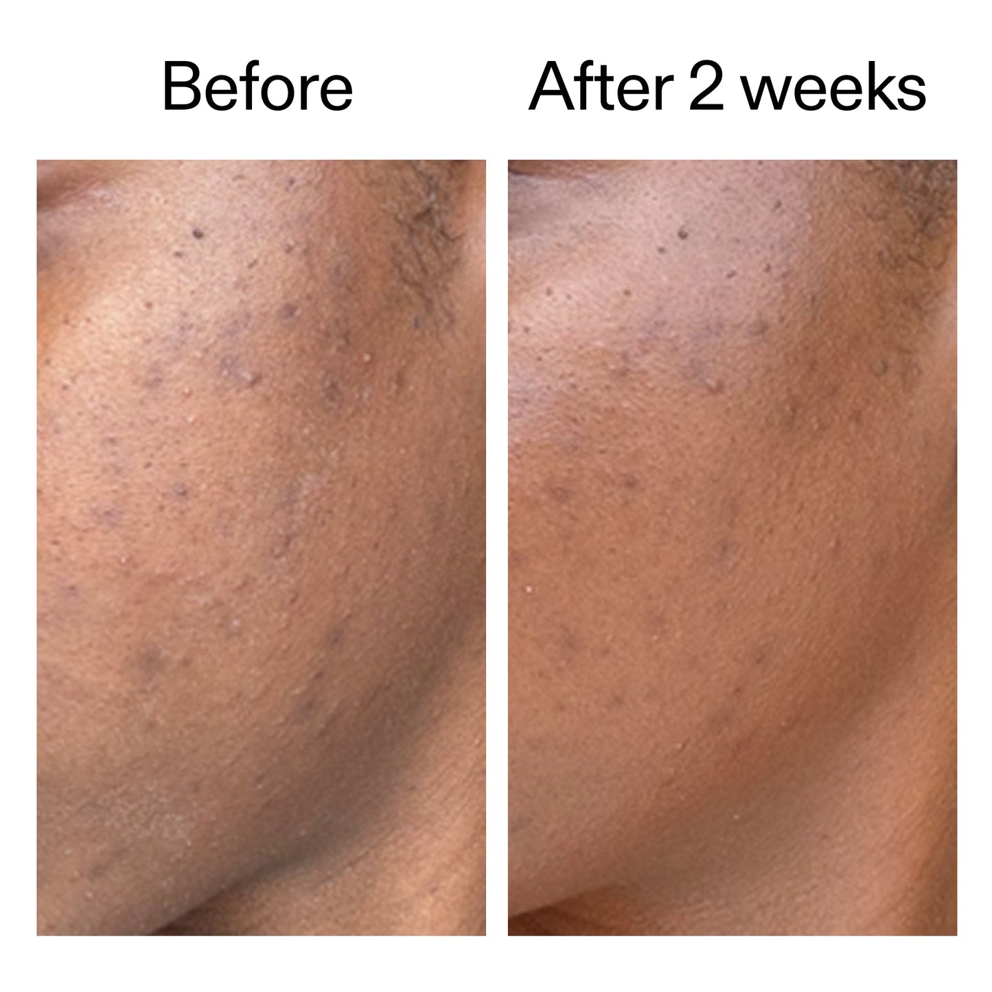 360-acne-clearing-duo-o3 DIOICB_A2000x2000.jpg