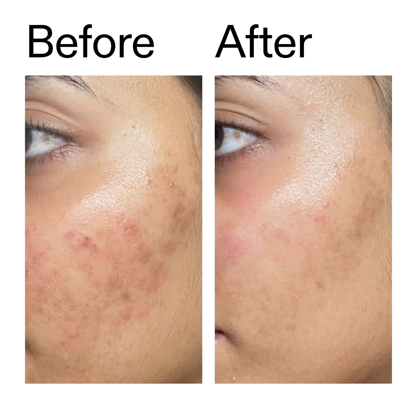 ectoin-hydro-barrier-serum-n4 Ectoin_Hydro-barrier_Serum__Before_After_2000x2000_34261920-d004-48d0-9c7b-8e1c15971bfd.jpg