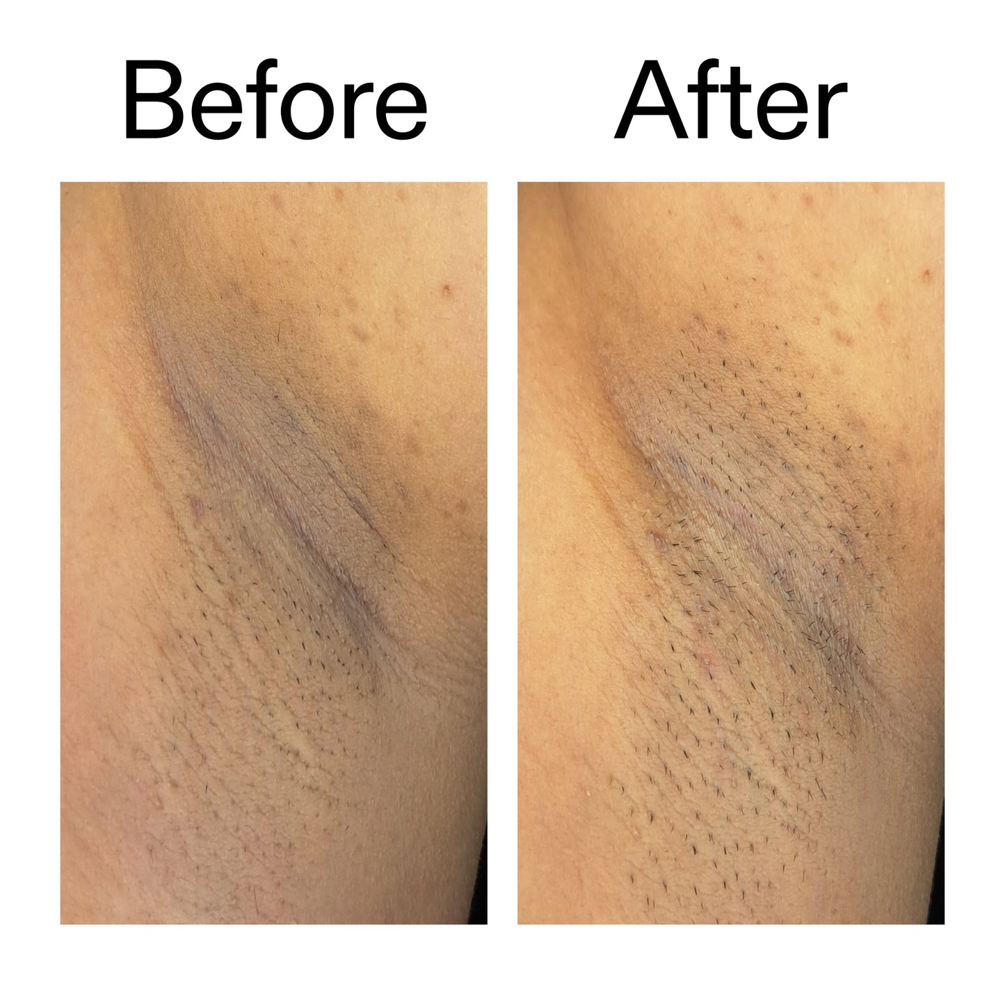 glycolic-acid-exfoliating-body-stick-c3 Glycolic_Acid_Exfoliating_Body_Stick_Before_After_V3_2000x2000_ea919cd9-1439-4a46-82a0-76200eb5bb42.jpg