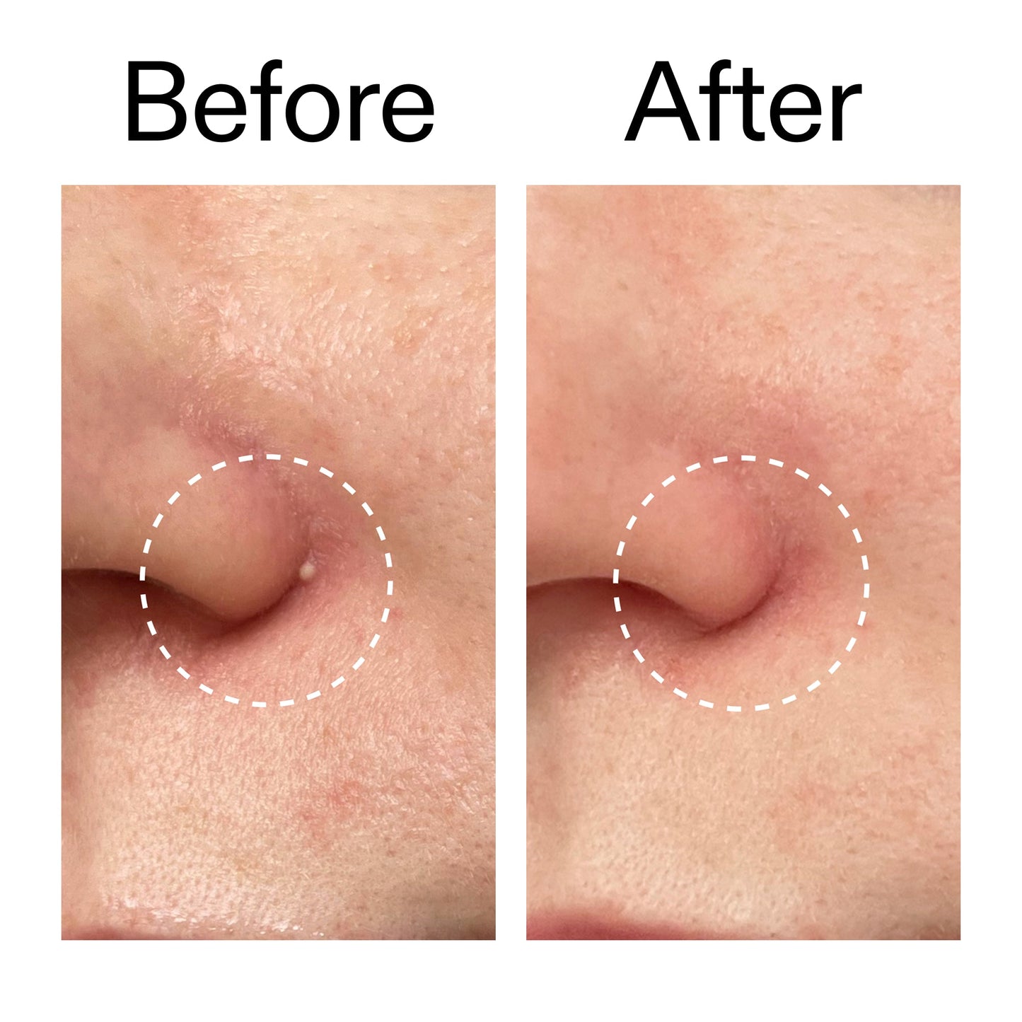 hydrocolloid-invisible-pimple-patches-pack-of-22-g9 Hydrocolloid_Invisible_Pimple_Patches_Before_After_2000x2000_b02aa37b-c78a-4682-91de-9135af5bb7df.jpg