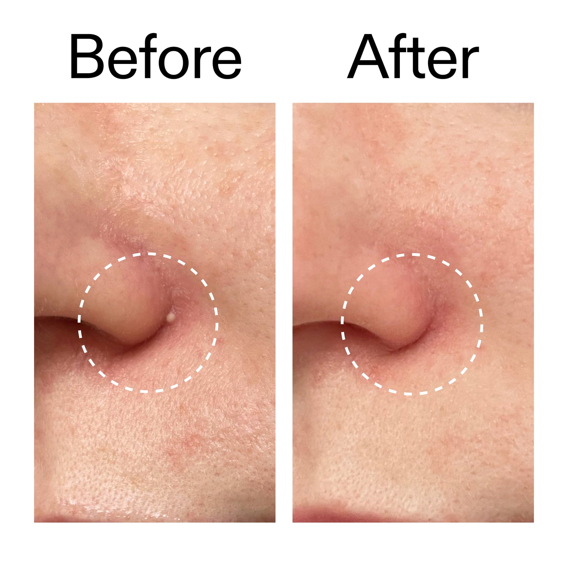 hydrocolloid-invisible-pimple-patches-pack-of-22-g9 Hydrocolloid_Invisible_Pimple_Patches_Before_After_2000x2000_b02aa37b-c78a-4682-91de-9135af5bb7df.jpg