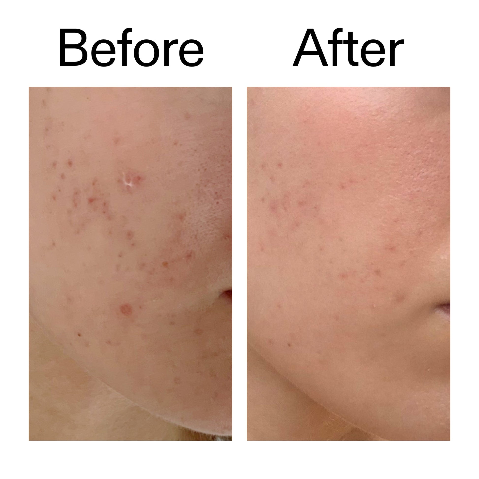 mandelic-acid-treatment-t2 Mandelic_Acid_Treatment_Before_After_2000x2000_4885ac6e-c5d7-4279-a72a-1417af7dce35.jpg