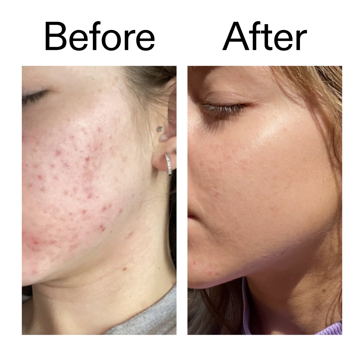 10-niacinamide-serum-duo-k7 Niacinamide_Serum_Before_After_2000x2000_bde32455-9e7d-448e-b053-bef41504f0a9.jpg
