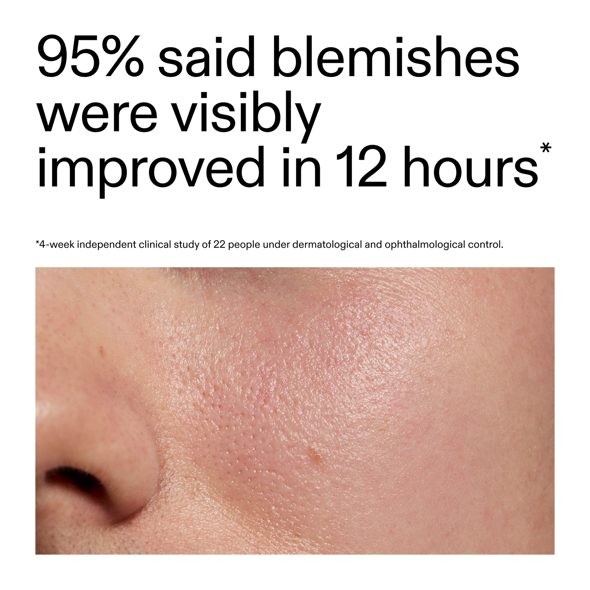 succinic-acid-acne-treatment-u3 Oat_Cleansing_Balm_Claim_2000x2000_ac6ce553-25db-41b2-a981-faae1ac4b8c0.jpg