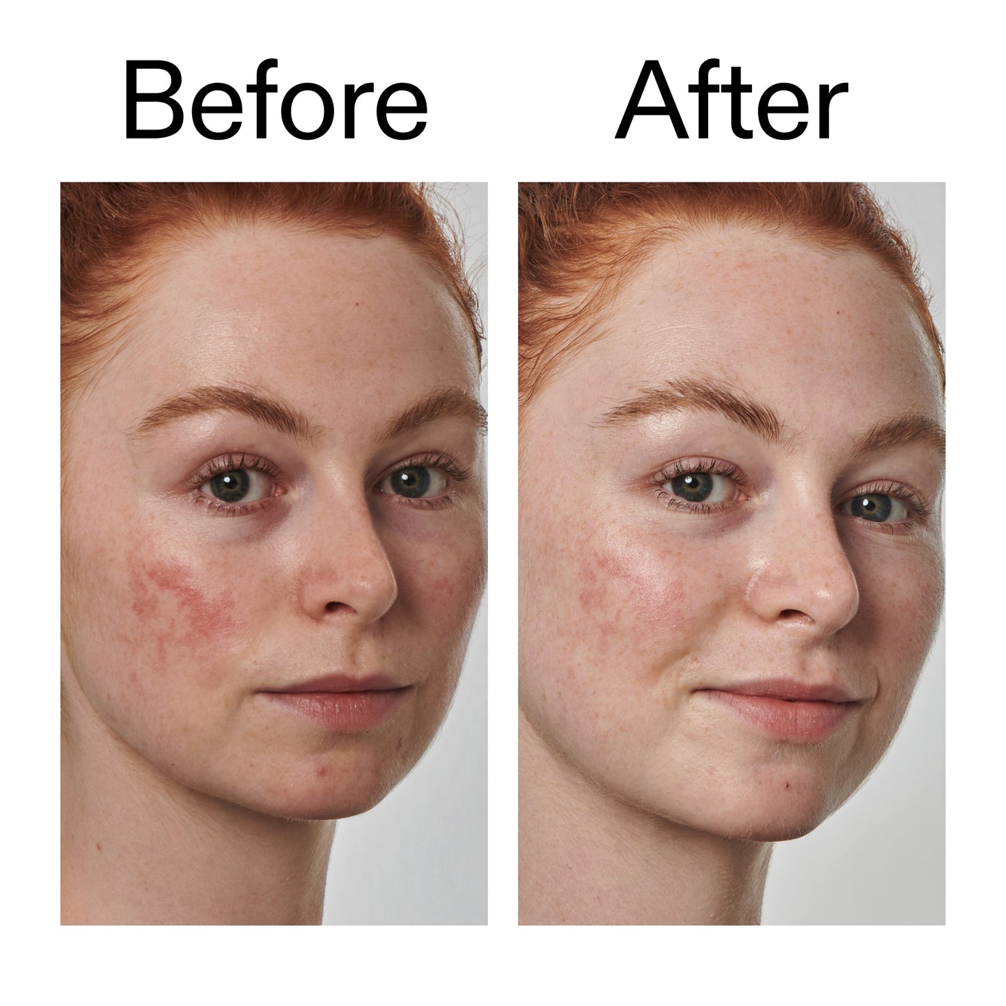 10-azelaic-acid-serum-for-redness-relief-m2 Redness_Relief_Serum_Before_After_2000x2000_3334dc9a-cce9-4e00-8aec-7ad89ca051f2.jpg