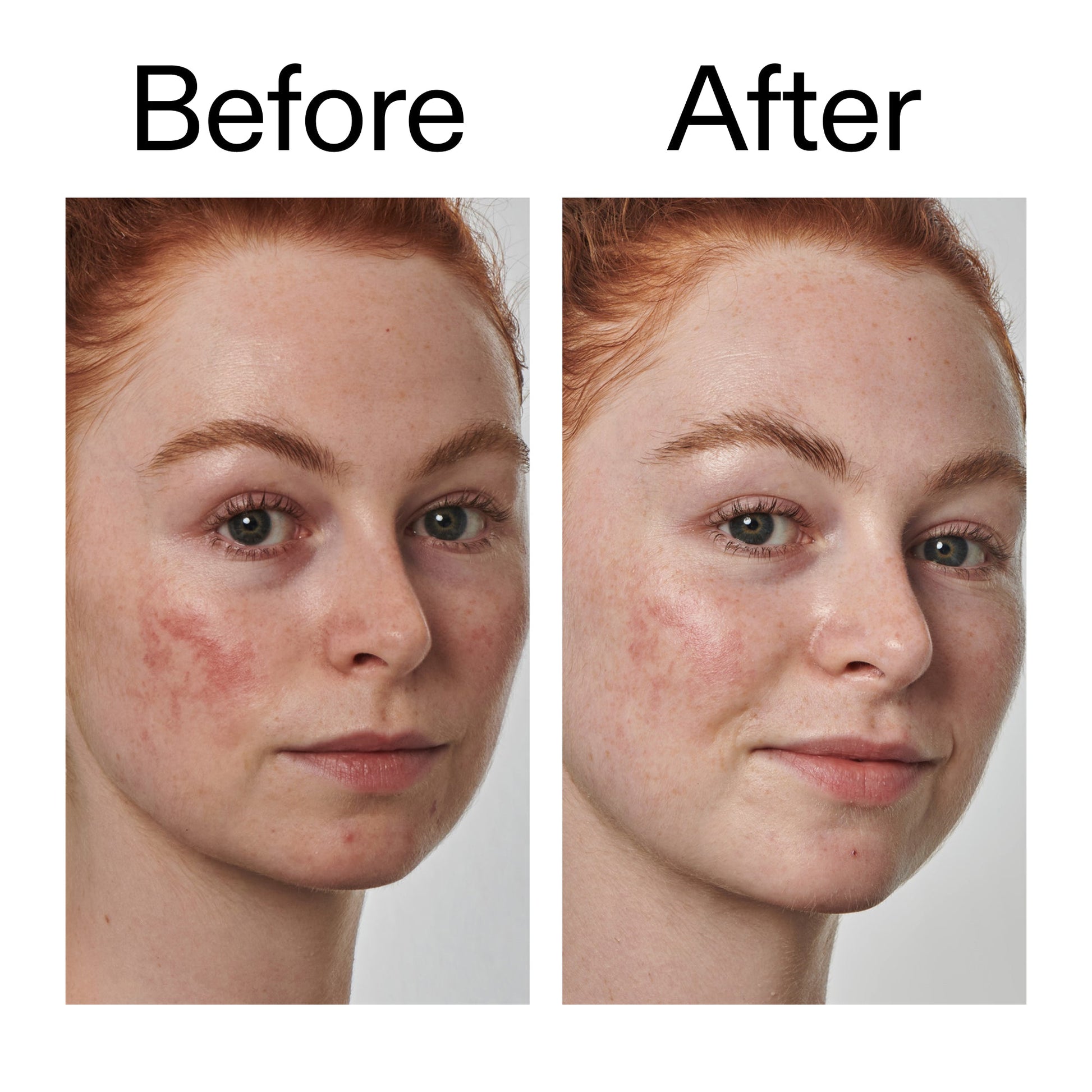 10-azelaic-acid-serum-for-redness-relief-m2 Redness_Relief_Serum_Before_After_2000x2000_3334dc9a-cce9-4e00-8aec-7ad89ca051f2.jpg