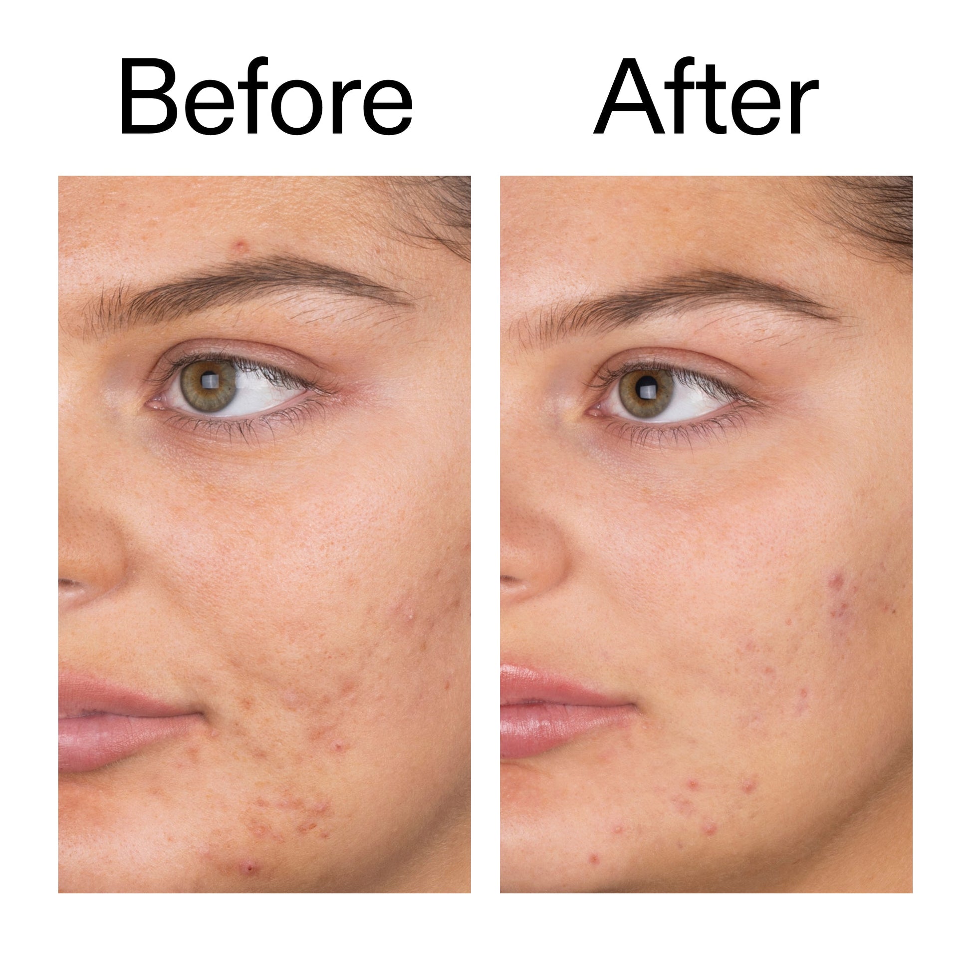 salicylic-acid-cleanser-150ml-h0 Salicylic_Acid_Cleanser_-_150ml_Before_After_2000x2000_e7230494-853f-4b07-82b1-27669104c995.jpg