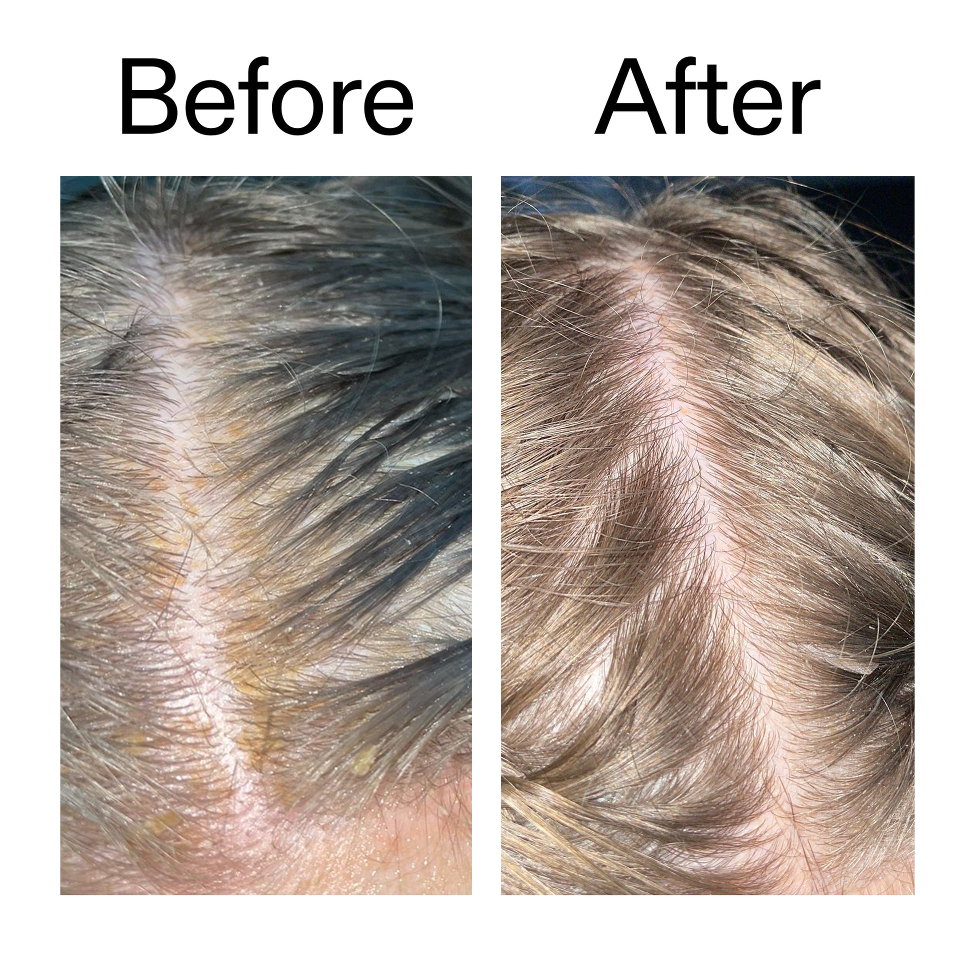 salicylic-acid-exfoliating-scalp-treatment-n2 Salicylic_Acid_Exfoliating_Scalp_Treatment_Before_After_2000x2000_e572a30f-057c-4a48-823b-1c09dc97f8d0.jpg