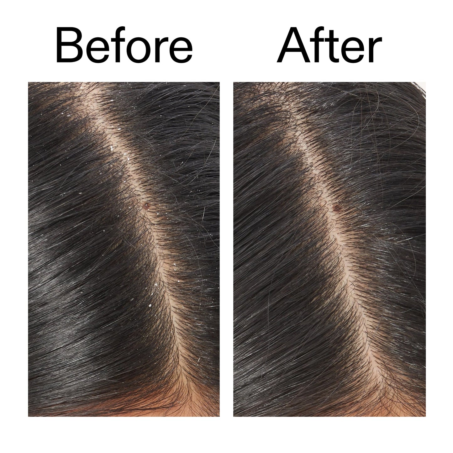salicylic-acid-exfoliating-scalp-treatment-n2 Salicylic_Acid_Exfoliating_Scalp_Treatment_Before_After_V2_2000x2000_02bd61ad-42bf-490b-b3e3-7e04b2e8a673.jpg