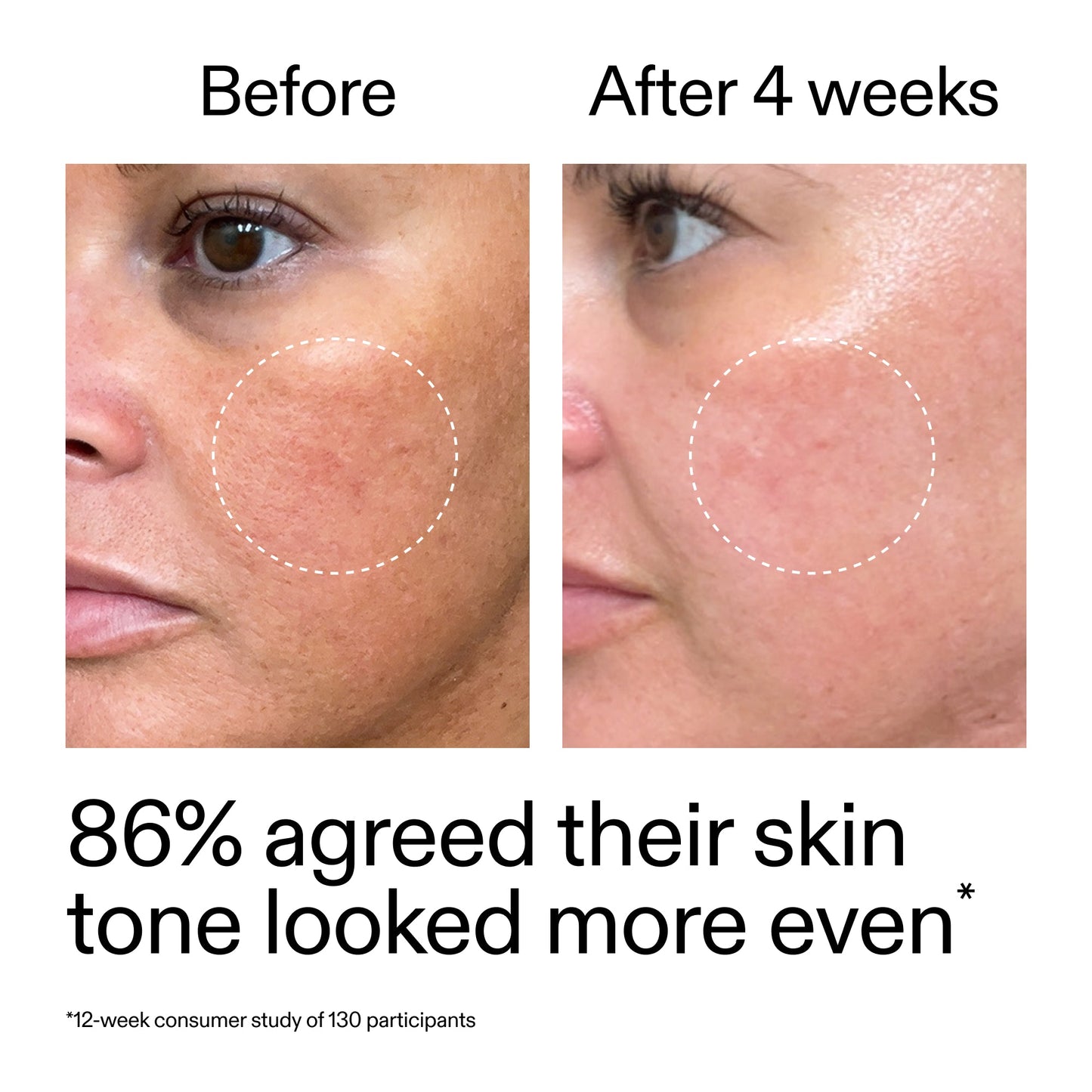 starter-retinol-serum-t2 StarterRetinol_BeforeAfter_Claim2_2000x2000_f5c9ecc0-8d76-429d-bef5-c3a61bcf5c09.jpg