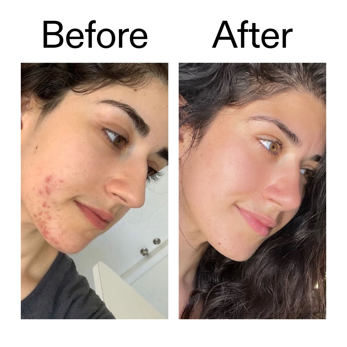 succinic-acid-acne-treatment-u3 Succinic_Acid_Treatment_Before_After_2000x2000_6a5f0054-2f58-4433-9314-0dc72c9bdd3b.jpg