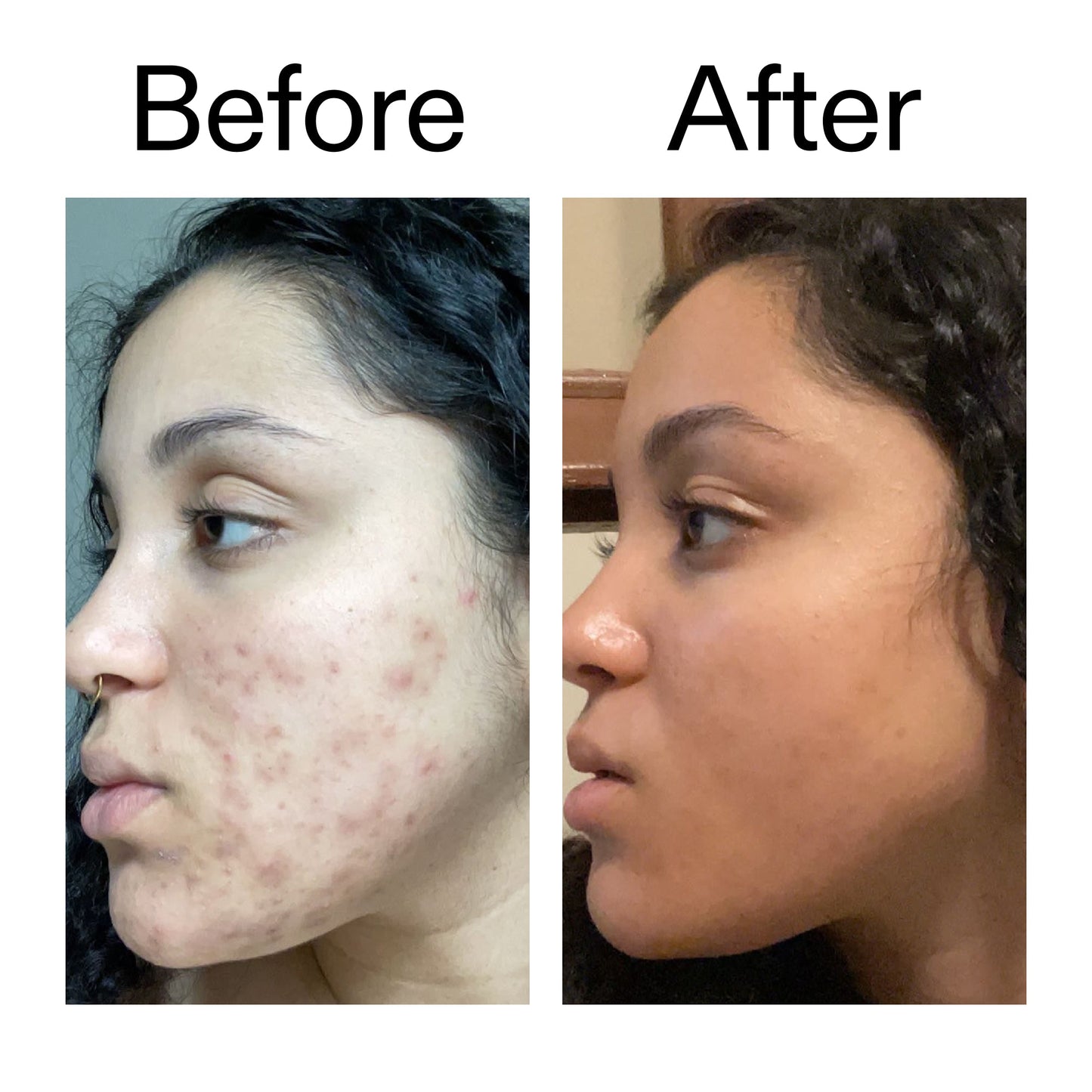 tranexamic-acid-serum-q7 Tranexamic_Acid_Serum_Before_After_2000x2000_98ebc8be-77b0-4843-8a22-90790ebe918b.jpg